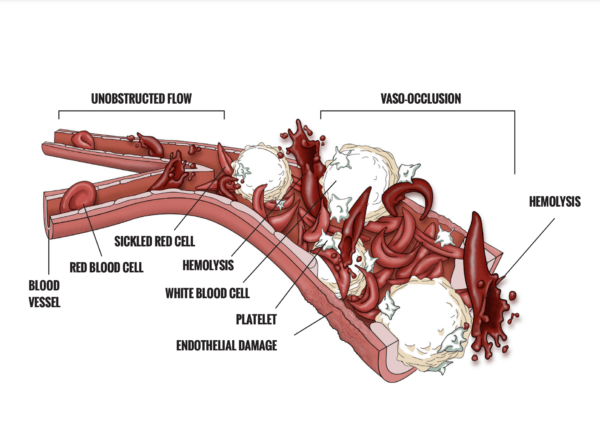 Sickle Cell Anemia Infographic showing endothelial damage, vaso-occlusion and hemeolysis